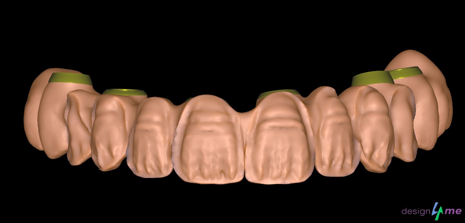 Modélisation prothèse dentaire 3D - design4me