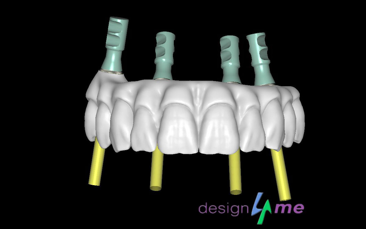 Modélisation prothèse dentaire 3D - design4me