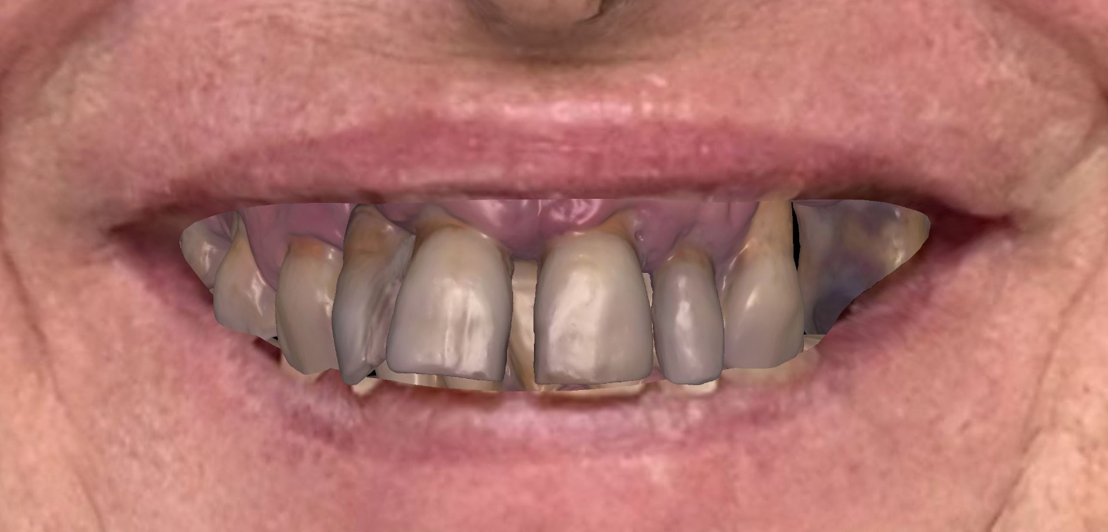 design4me modelisations 3d de prothèses dentaires pour laboratoires